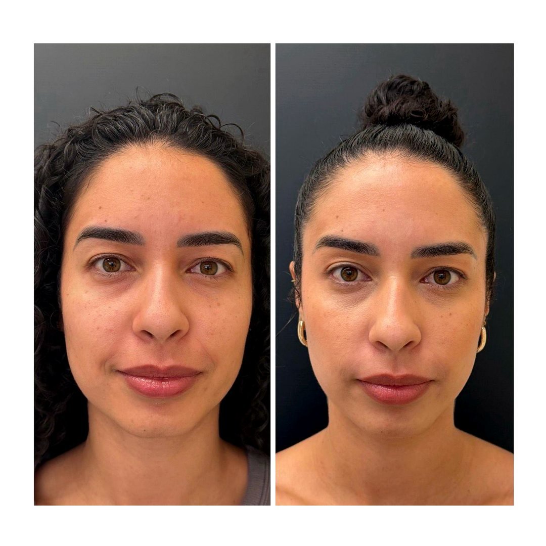Antes e depois de Bioestimulador e linhas de expressão com a Dra. Loliane Zanon em Brasília