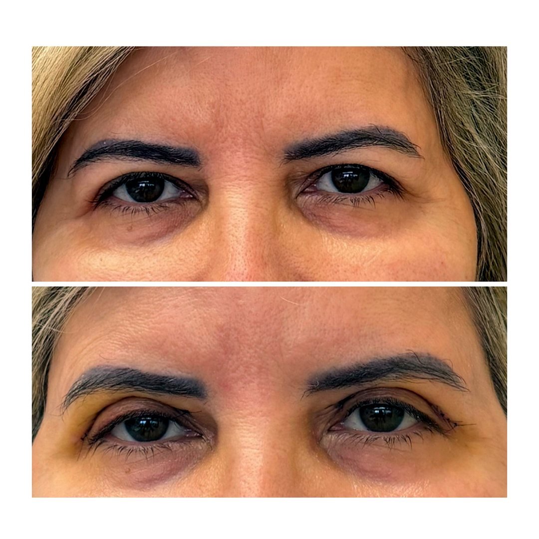 Antes e depois de Blefaroplastia com a Dra. Loliane Zanon em Brasília
