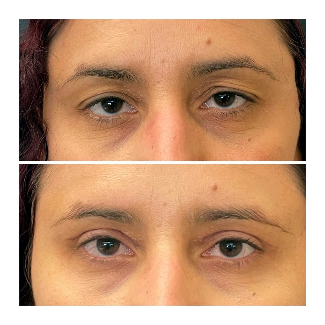 Antes e depois de Blefaroplastia com a Dra. Loliane Zanon em Brasília