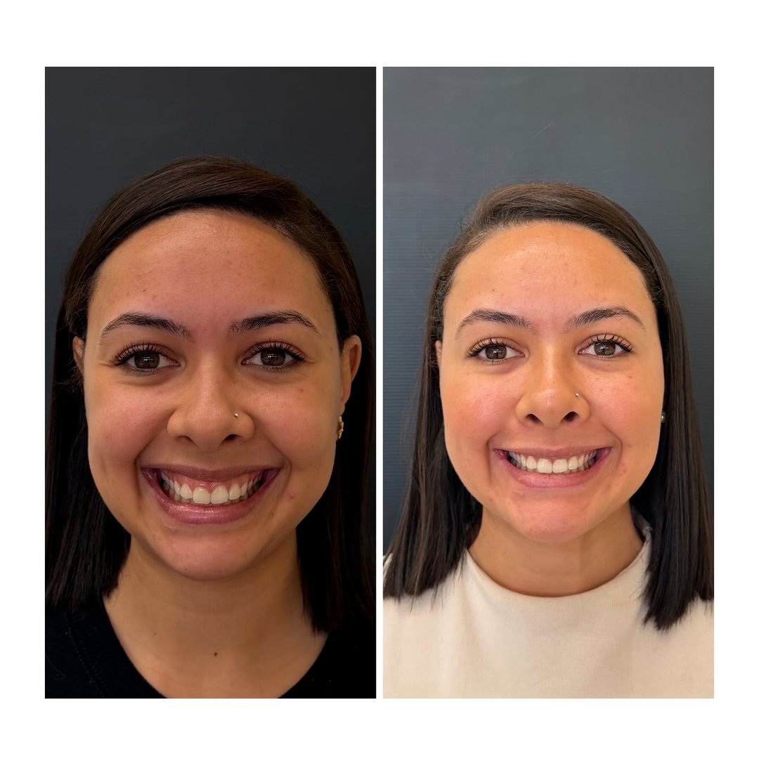 Antes e depois de Full face com a Dra. Loliane Zanon em Brasília