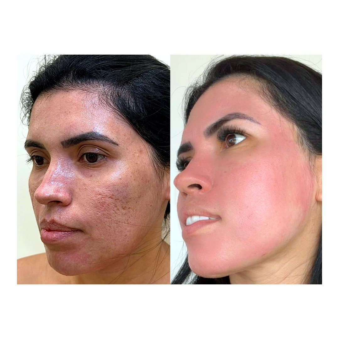 Antes e depois de Perfect Peel com a Dra. Loliane Zanon em Brasília