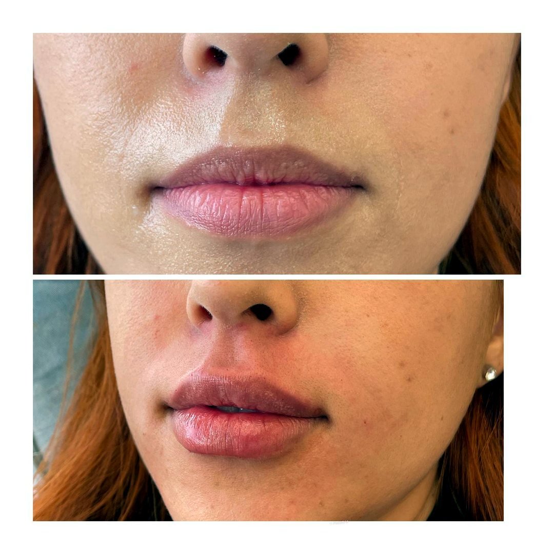 Antes e depois de Preenchimento labial com a Dra. Loliane Zanon em Brasília