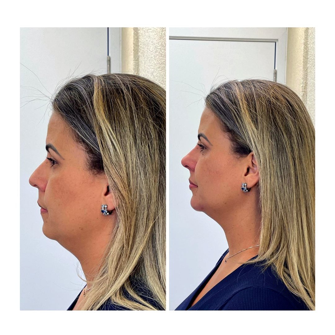 Antes e depois de Projeção de queixo com a Dra. Loliane Zanon em Brasília
