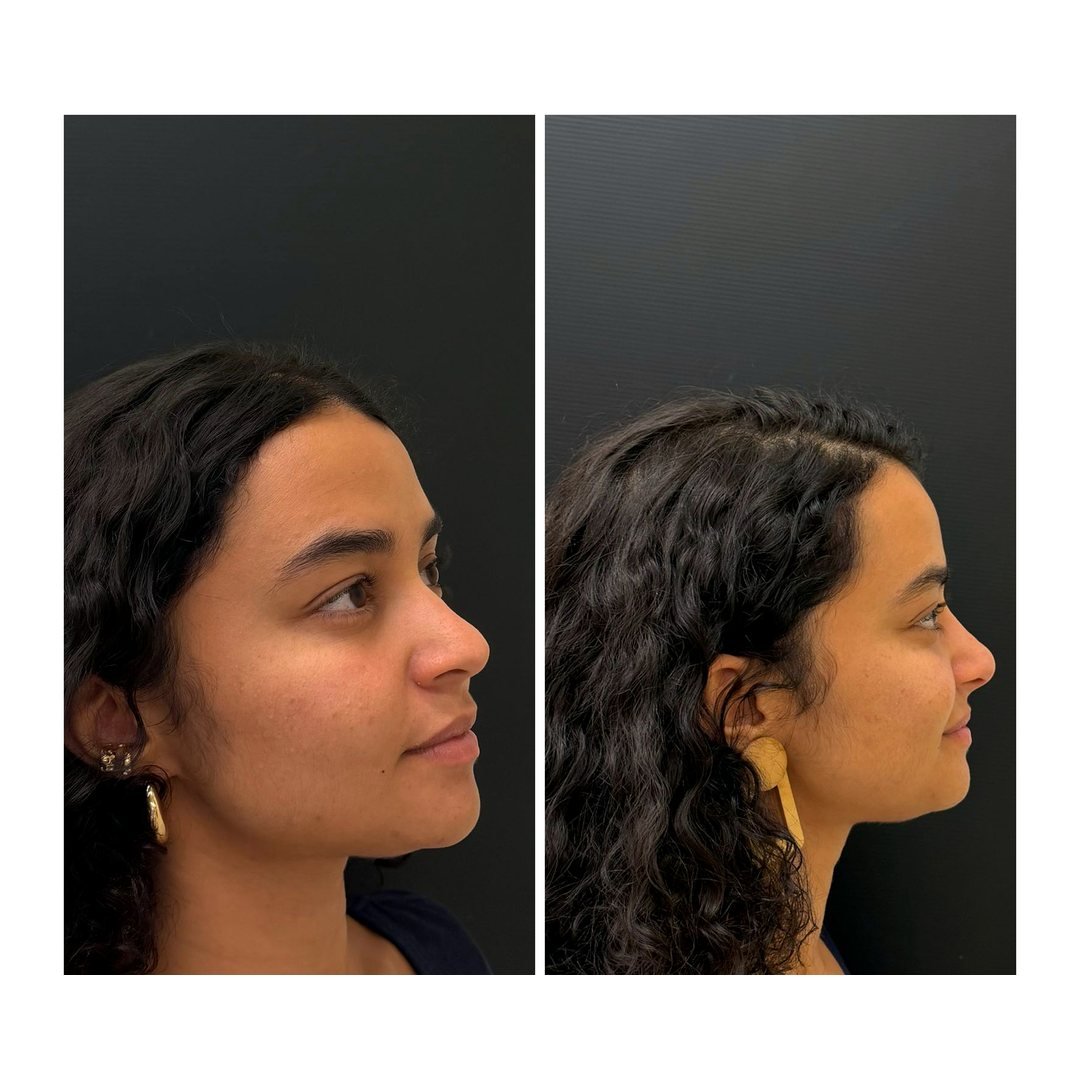 Antes e depois de Rinomodelação com a Dra. Loliane Zanon em Brasília